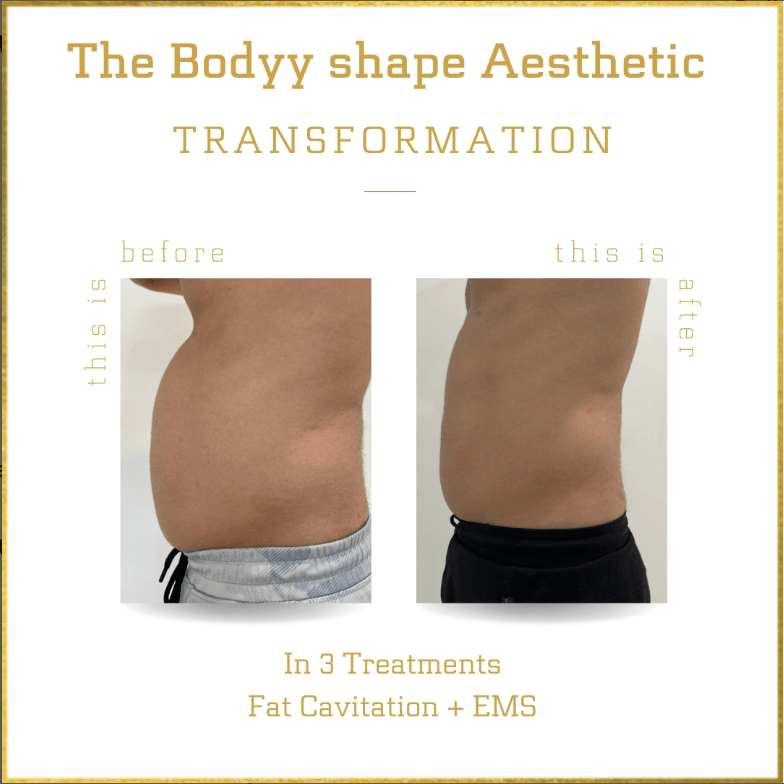 Fat Cavitation Treatment Adelaide