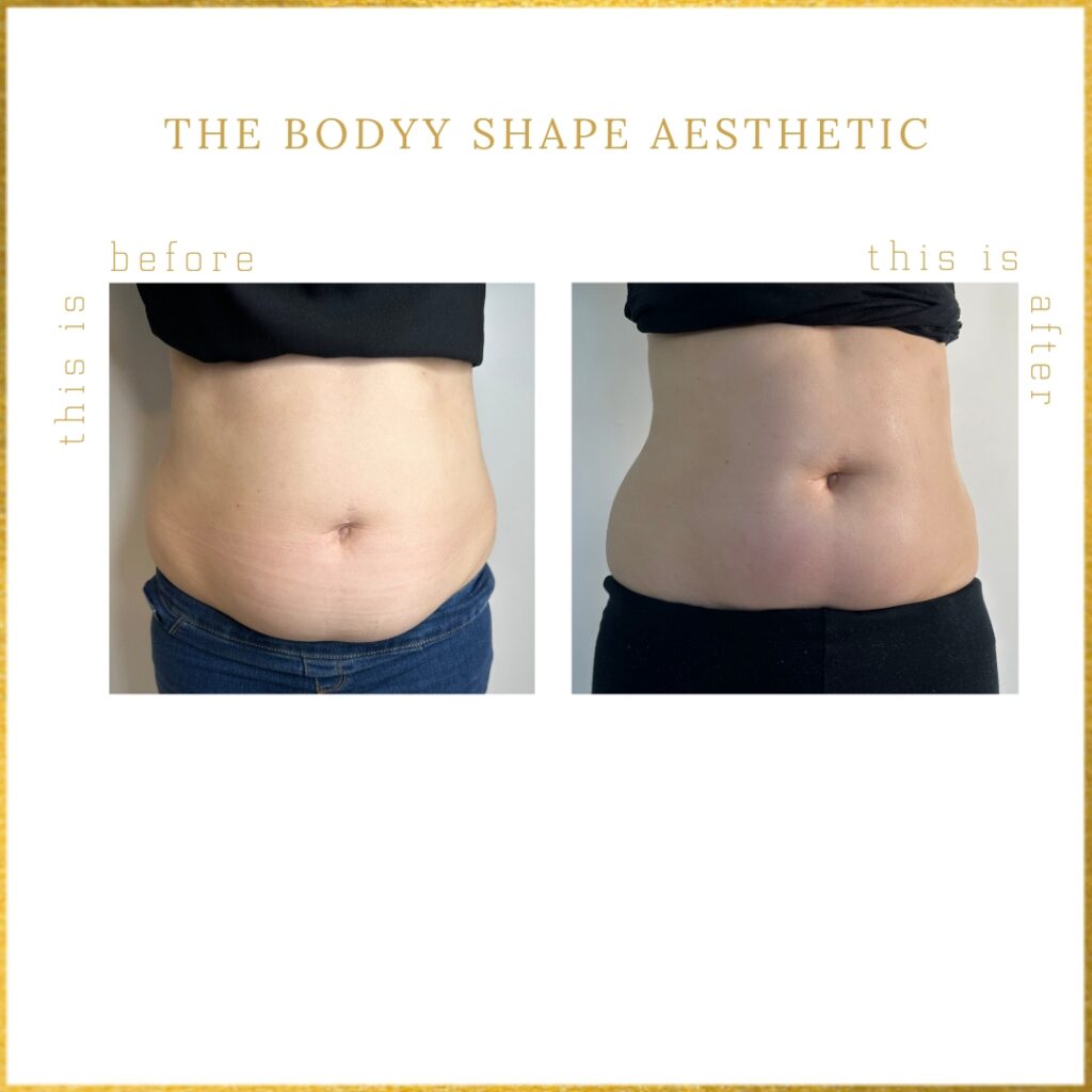 body shaping adelaide