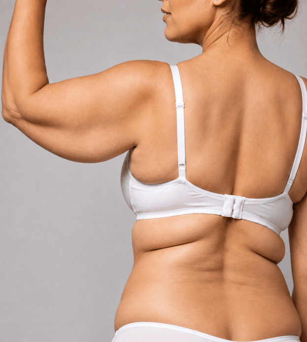 Arm and back body contouring treatment at our Brisbane clinic