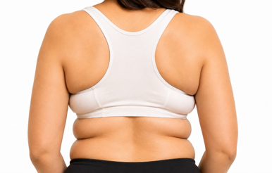 Fat Cavitation for Bra fat & back bulge in Brisbane