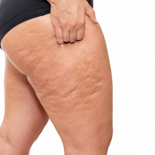 Cellulite Appearance
