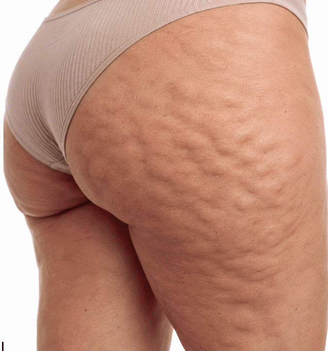 Cellulite & Uneven Body Texture