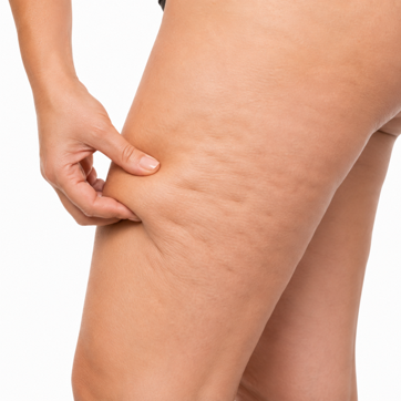 Cellulite