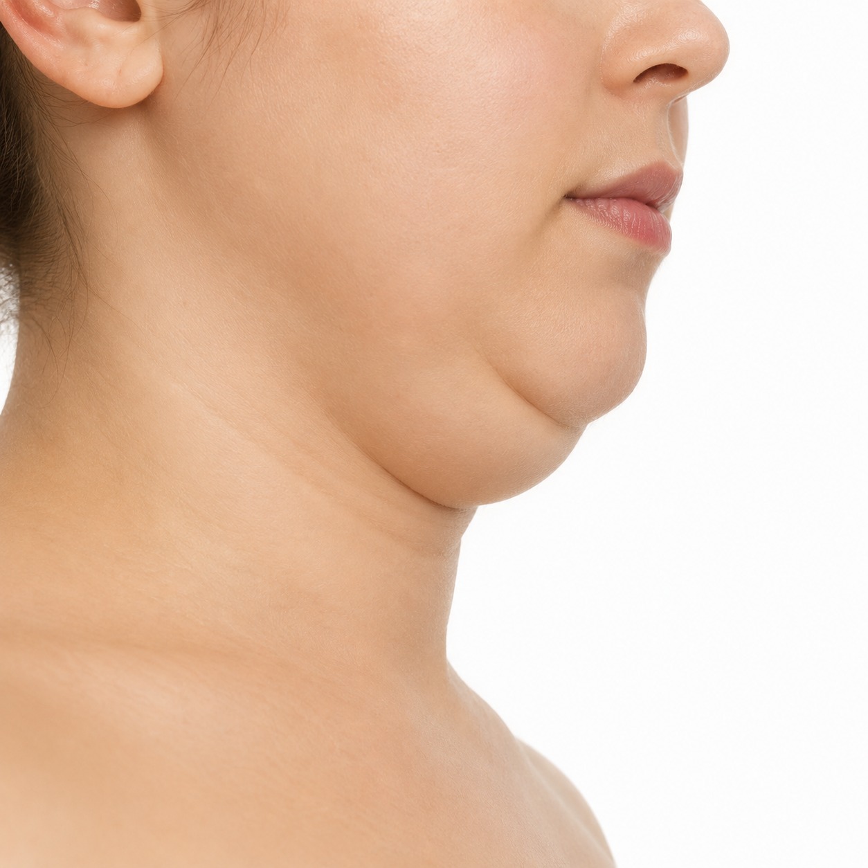 Double Chin Treatment in Brisbane