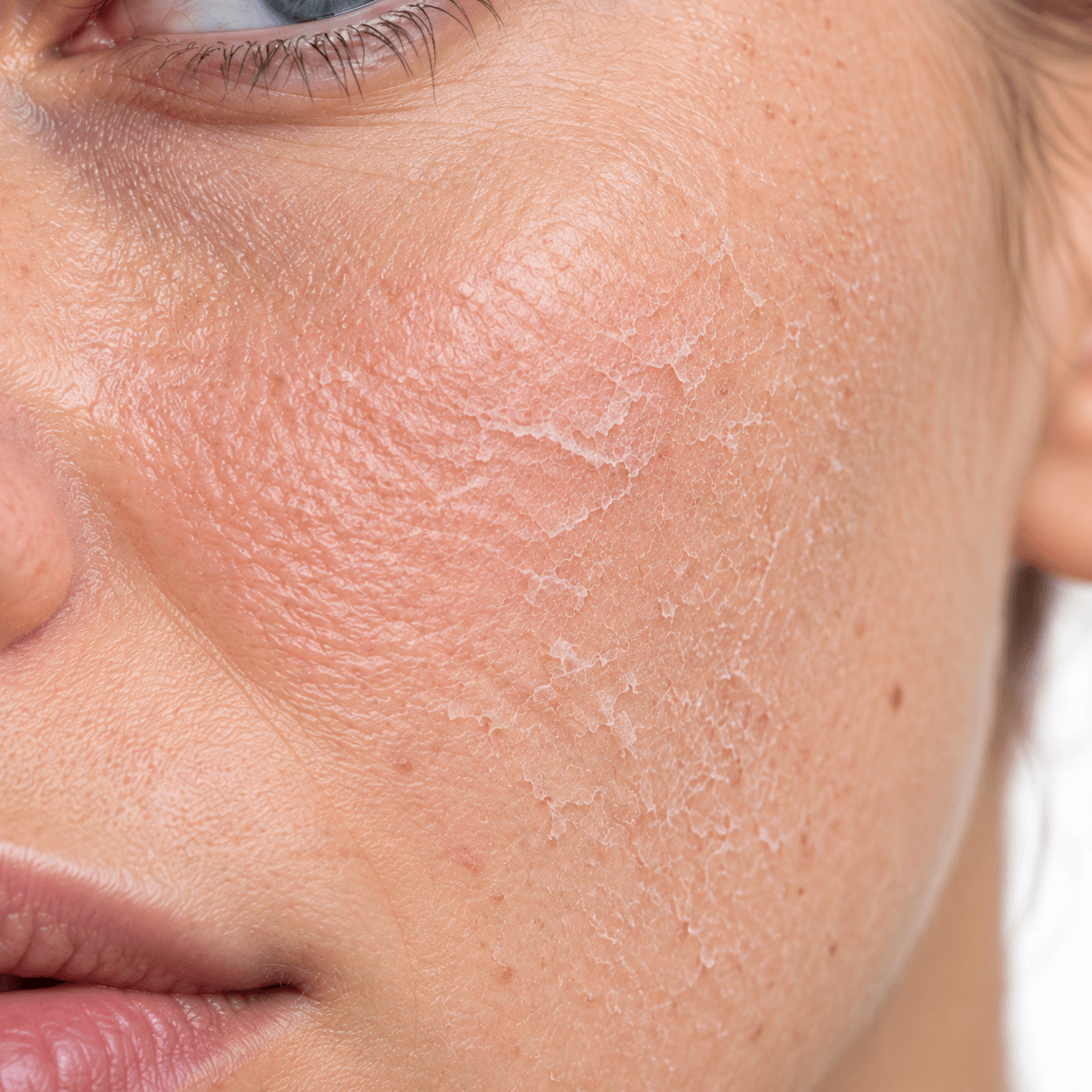 Exfoliation