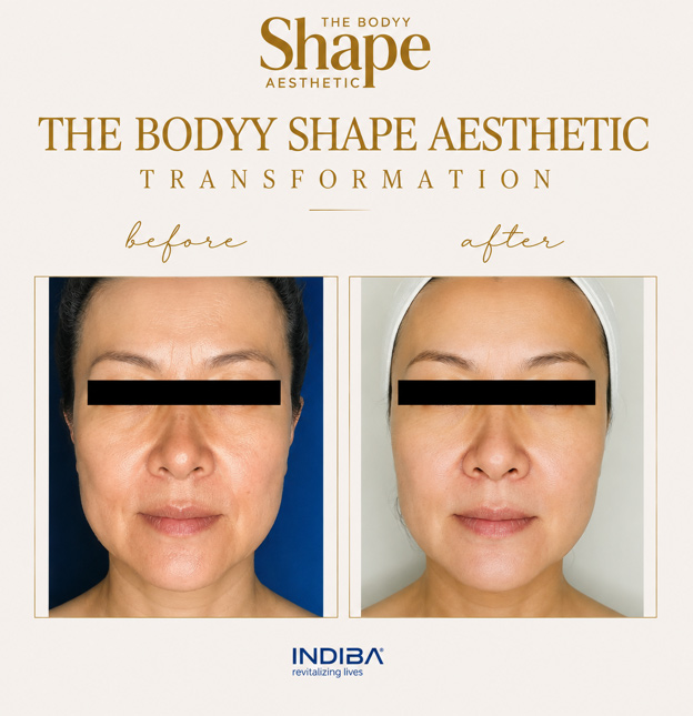 Indiba-Treatment Before-&-After1