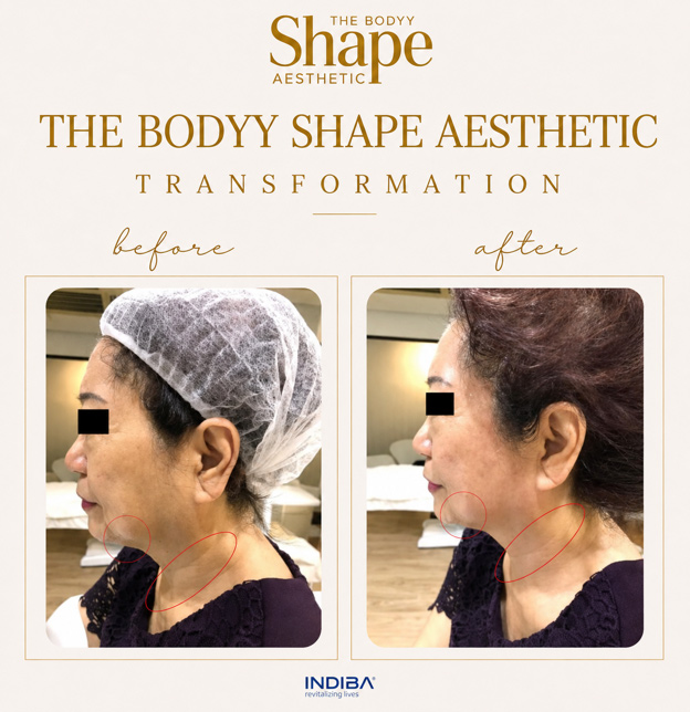 Indiba-Treatment Before-&-After