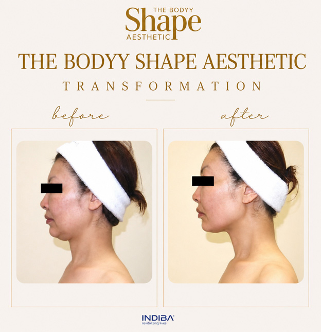 Indiba-Treatment Before-&-After