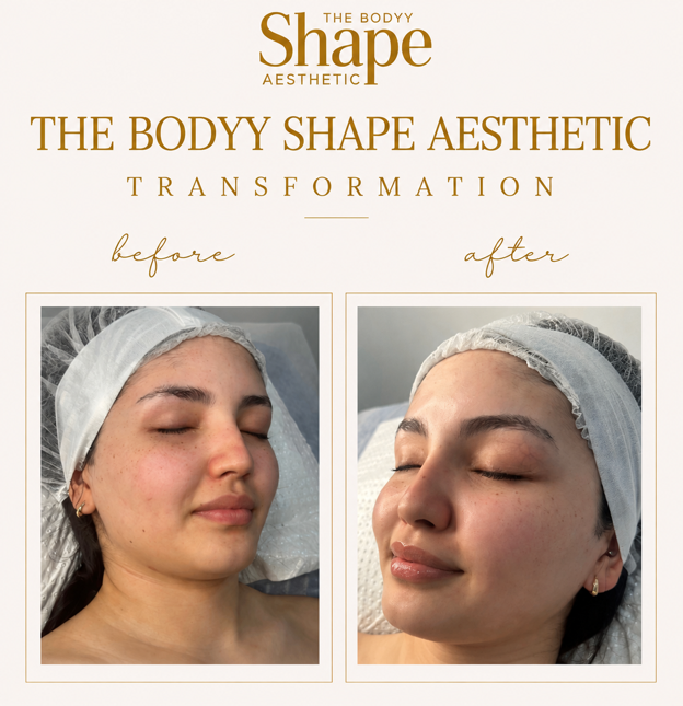 Microdermabrasion before and after