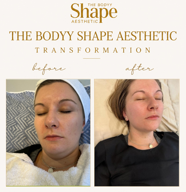 Microdermabrasion before and after