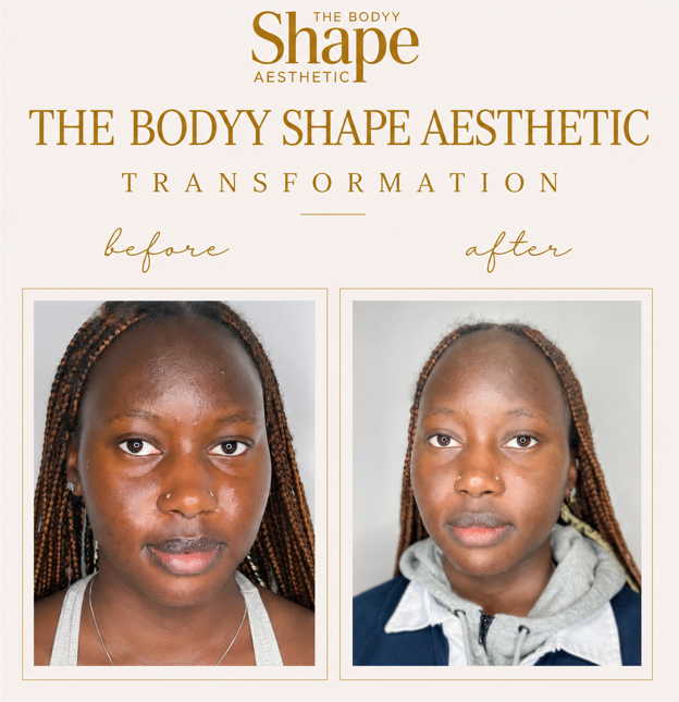 Microdermabrasion before and after