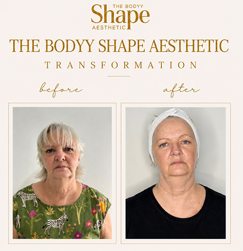 Microdermabrasion-before-and-after