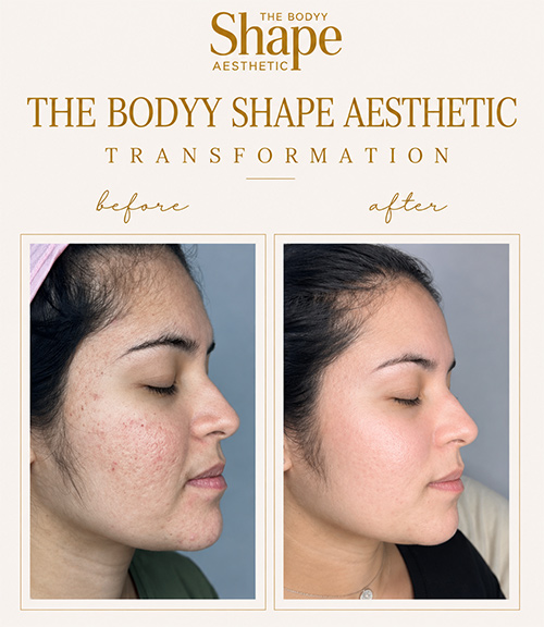Microdermabrasion-before-and-after