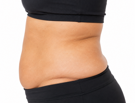 Muffin top and waistline fullness