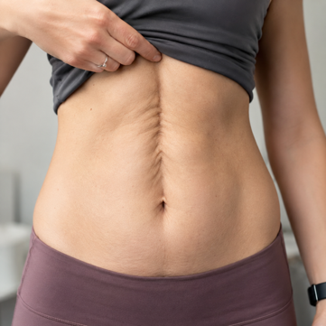 Post-Pregnancy Muscle Separation and Weakness