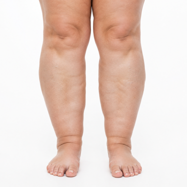 Puffy, heavy or tired legs