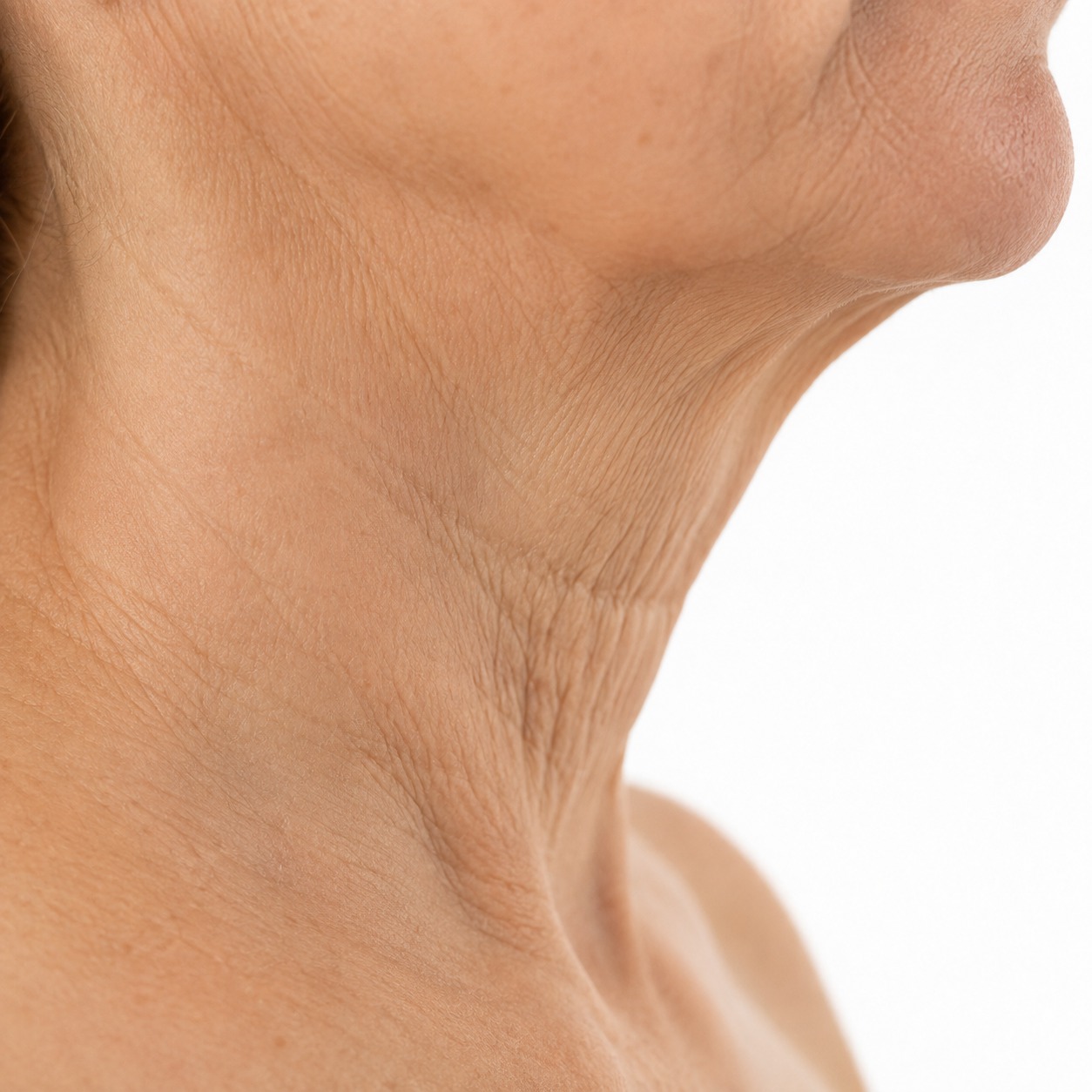 Skin Laxity Treatment in Brisbane