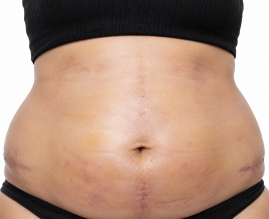 Swelling after liposuction or other surgery