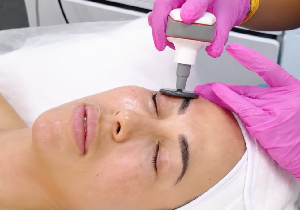 What Is RF Skin Tightening?