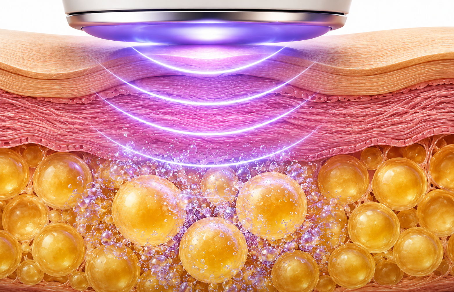 What Is Ultrasound Fat Cavitation, Exactly?