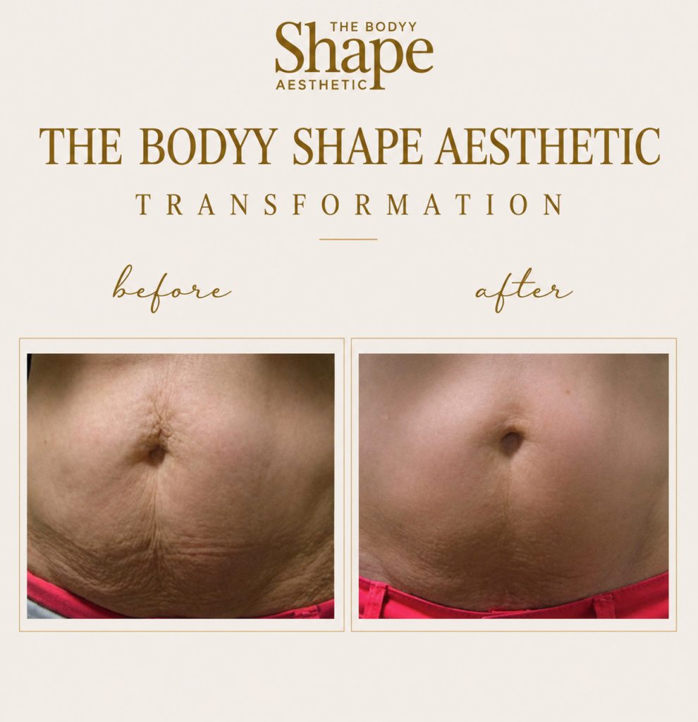 Vanquish ME™ Fat Reduction Treatment treatment result