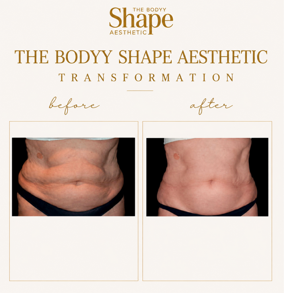 Vanquish ME™ Fat Reduction Treatment treatment result