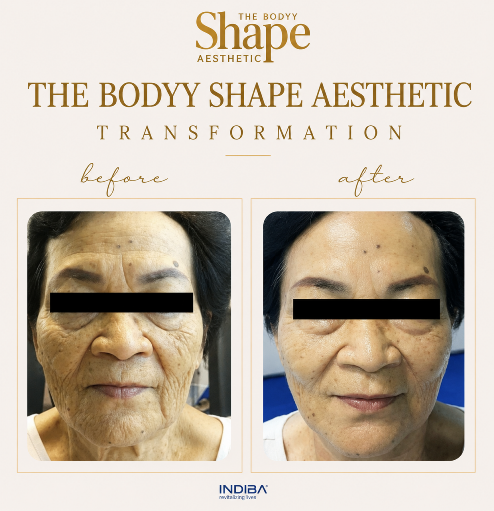 INDIBA Skin Tightening Treatment treatment result