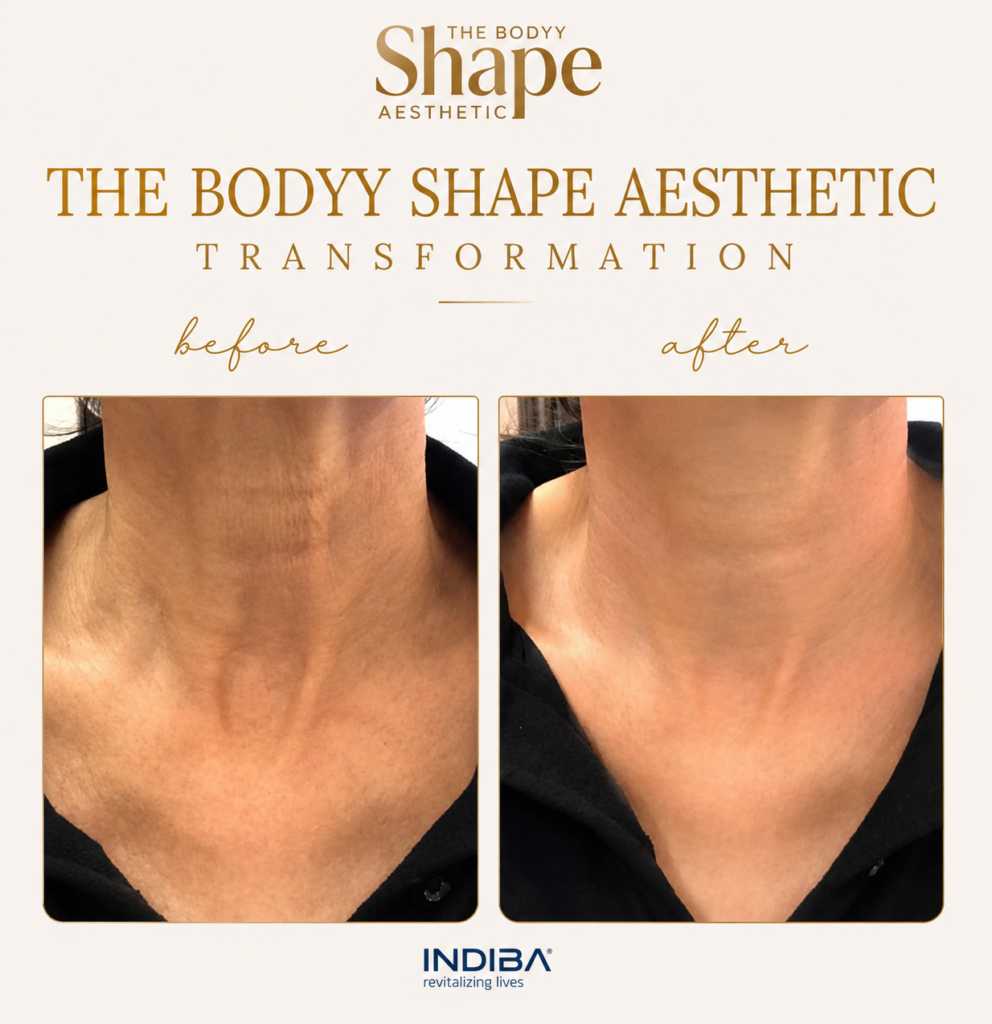 INDIBA Skin Tightening Treatment treatment result