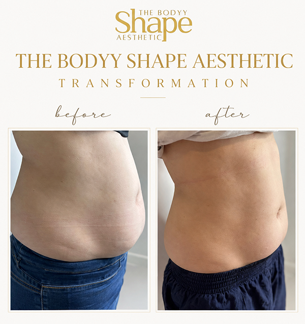 Before & After of a Man After Fat Cavitation Sessions in The Bodyy Shape Aesthetic