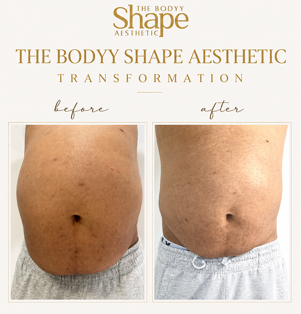 Result After Few Session of Fat Cavitation on Stomach area at The Bodyy Shape Aesthetic