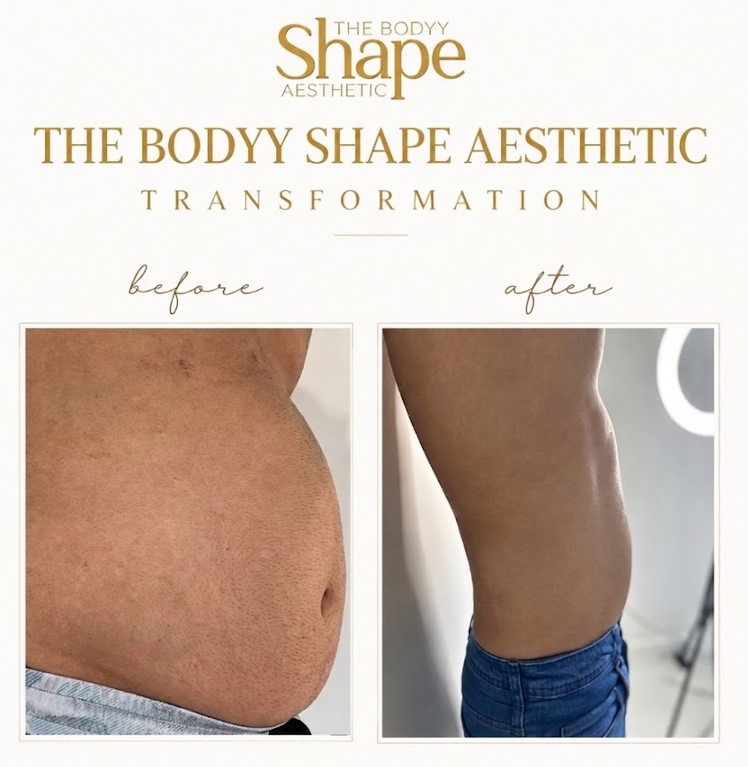 Before & After of a Man After Few Cavitation Sessions in The Bodyy Shape Aesthetic